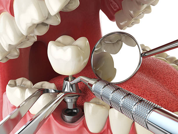 Best Emergency Denture Repair in Carlisle, KY
